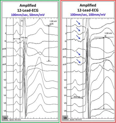 Amplified sinus-P-wave analysis predicts outcomes of cryoballoon ablation in patients with persistent and long-standing persistent atrial fibrillation: A multicentre study